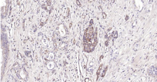 Immunohistochemical analysis of paraffin embedded human pancreatic cancer tissue slide using IHC0202H (Human CRIM1 IHC Kit).
