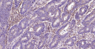 Immunohistochemical analysis of paraffin embedded human colon cancer tissue slide using IHC0205H (Human HLA E IHC Kit).