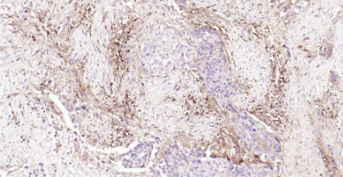 Immunohistochemical analysis of paraffin embedded human esophageal cancer tissue slide using IHC0205H (Human HLA E IHC Kit).