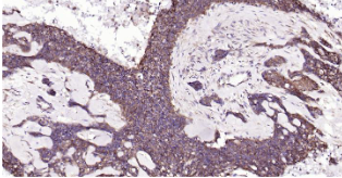 Immunohistochemical analysis of paraffin embedded human breast cancer tissue slide using IHC0206H (Human NFKB p65 IHC Kit).